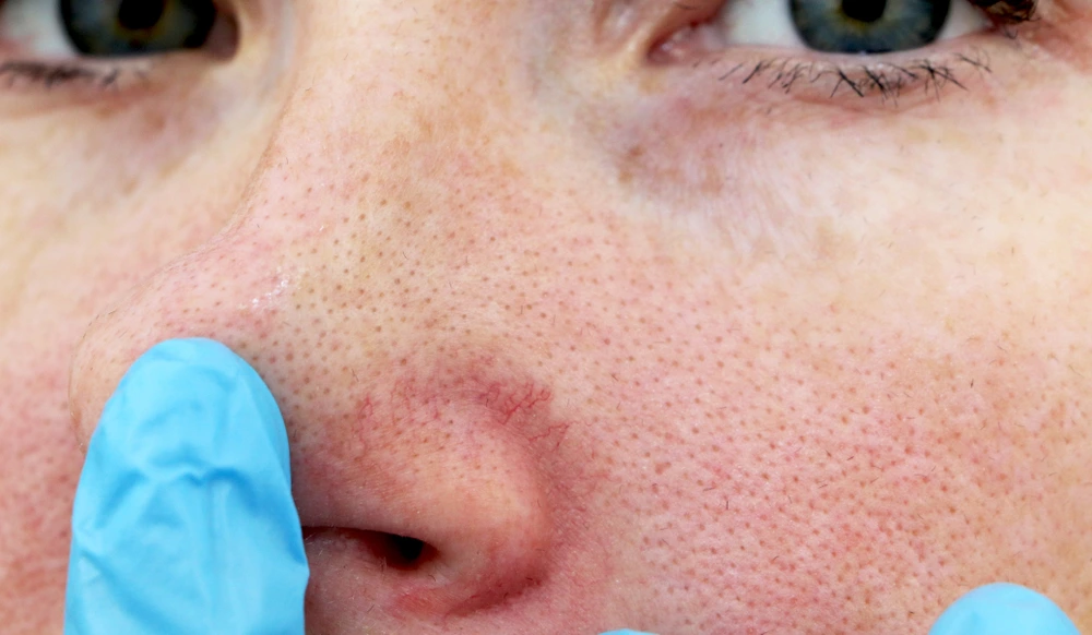 Traitement par laser des télangiectasies au cabinet du docteur Julien Vivier Paris