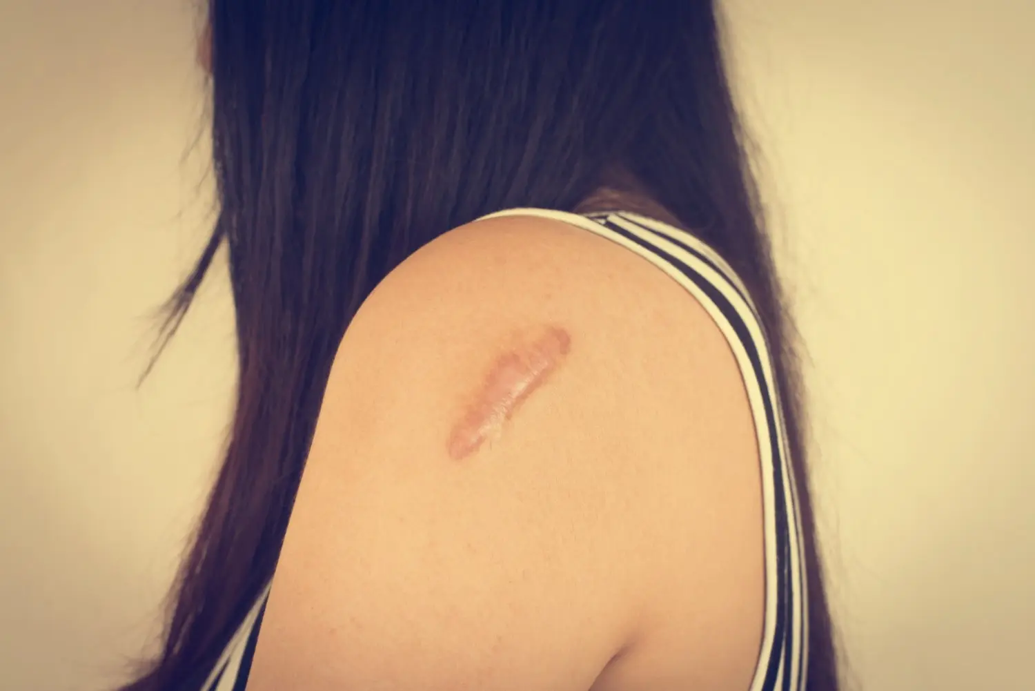 Image d'une femme avec une cicatrice sur le bras